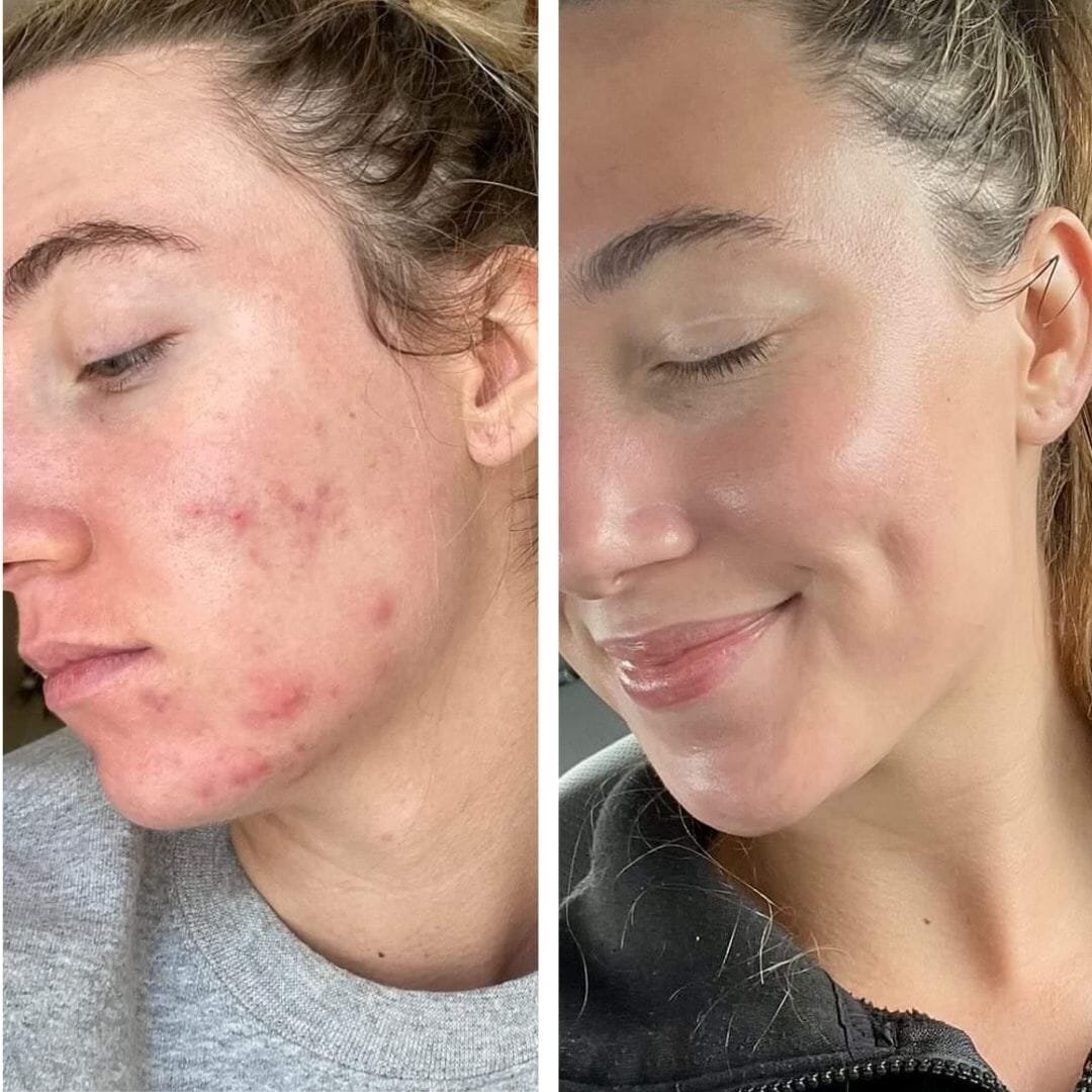 Dermapen Kollagen Boost PRO